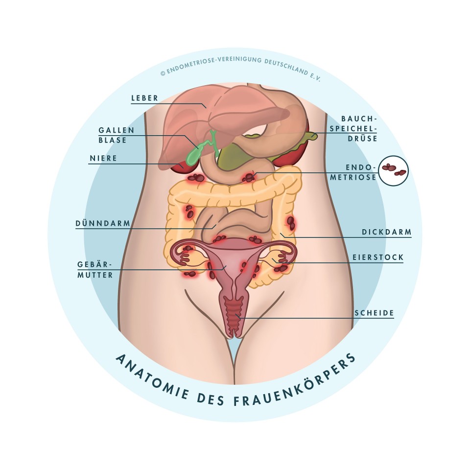 Endometriose-Herde können sich im gesamten Körper ausbreiten.